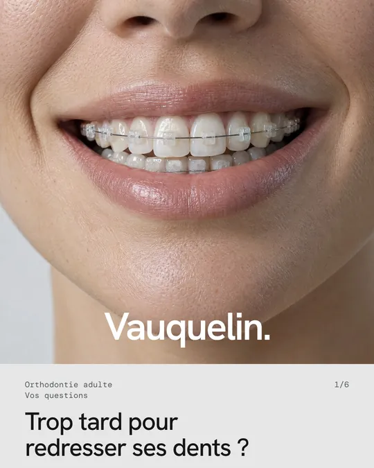 Première image&nbsp;: un sourire avec des attaches céramique, «&nbsp;Trop tard pour redresser ses dents&nbsp;?&nbsp;»